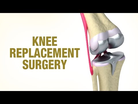 Knee Replacement Surgery - Dr. Vivek Allahabadia - Joint plus