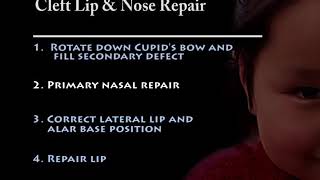 Cleft Nose Anatomy