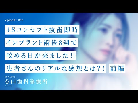 第56話 ４Sコンセプト抜歯即時 インプラント術後8週で咬める日が来ました‼️患者さんのリアルな感想とは？！ 前編 -札幌駅前-赤れんがテラス-谷口歯科診療所