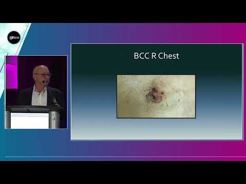 Superficial Radiation Therapy for NMSK