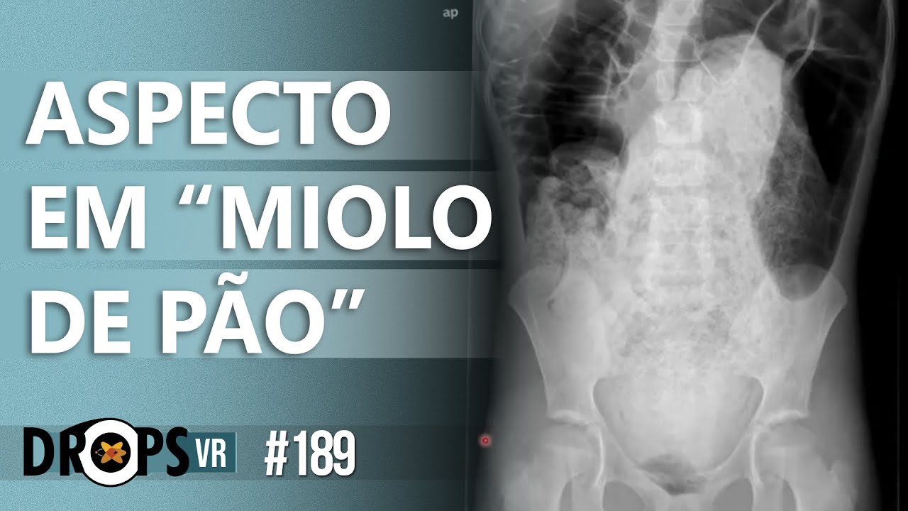ASPECTO EM “MIOLO DE PÃO” NO RAIO-X