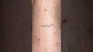 My legs before &amp; after IPL hair removal #beauty #hairremovaltips