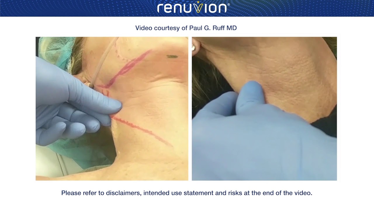 Renuvion (previously J-plasma) Neck Tightening. See the results for yourself