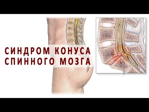Наколенники коленного сустава как выбрать где купить Артрит детский коленного сустава