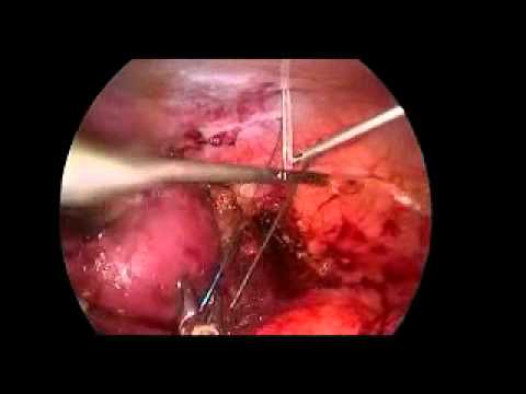 Transvaginal Nephrectomy - Ureter Retraction 