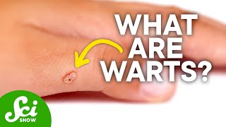 What's the Deal with Warts?