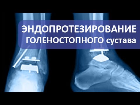 Сильная скованность шейно грудного отдела лечение Боль в шее больно дышать