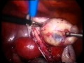 Bilateral Multiple Ovarian Teratoma in a patient.