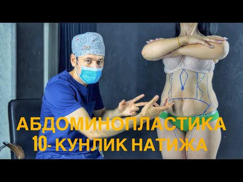 Abdominoplastika — Dr. Choriyev #2