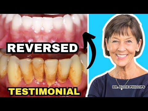 Gum Recession and Bone Loss Reversed (Testimonial)