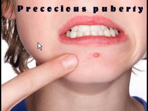 Videos for Precocious Puberty