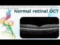 OCT 2 | Normal retinal OCT