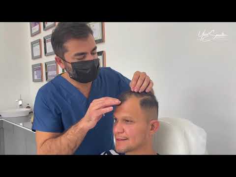 LA EXPERİEONCİA DE NUESTRO PACİENTE CARLOS ( 1 ANO ) TRANSPLANTES CAPİLARES