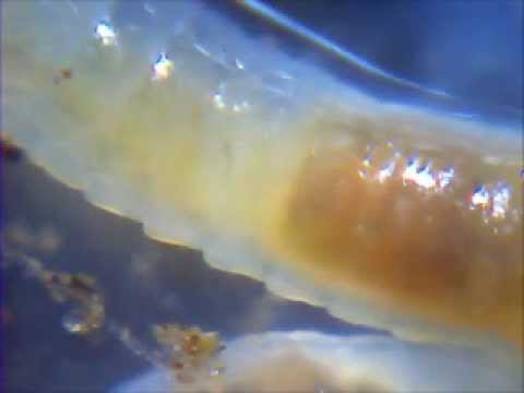 Milyen betegséget okozhatnak a pinwormok