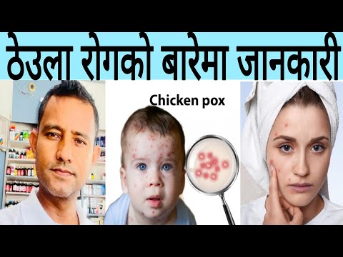 , title : 'Chicken pox रोग in Nepali |ठेउला रोगको औषधि उपचार | chickenpox scarps कसरी हटाउने? #स्वास्थ्य'