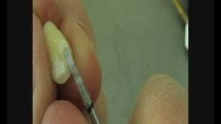 preview picture of video 'canine shaping on acrylic tooth'