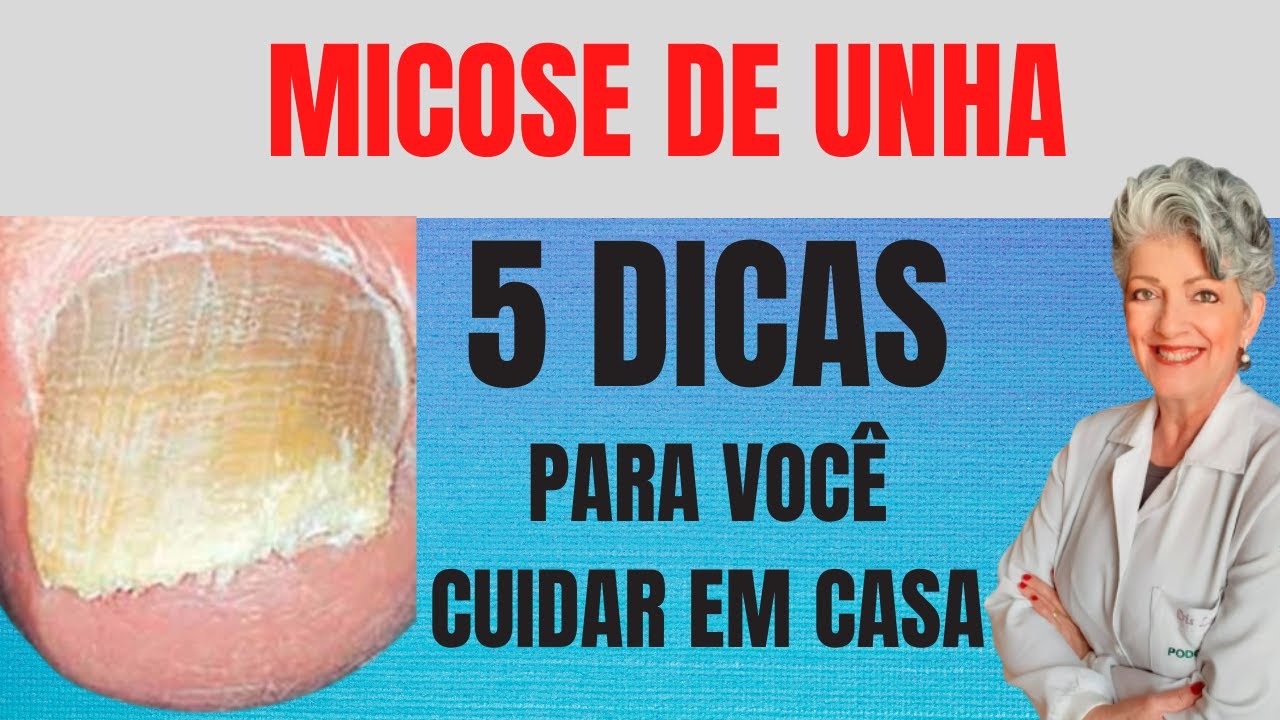 Micose de Unha O Que Fazer Em Casa