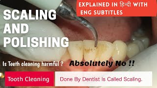 How Scaling is done ? | Teeth cleaning | Scaling and Polishing