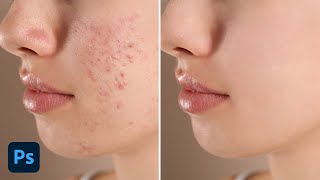 How To Easily Remove Acne & Blemishes In Photoshop
