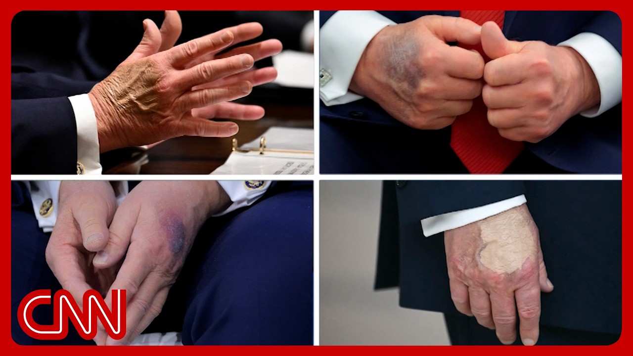 Trump's physical exam: What doctors are watching for