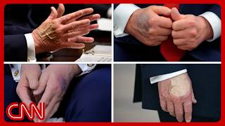 Trump's physical exam: What doctors are watching for