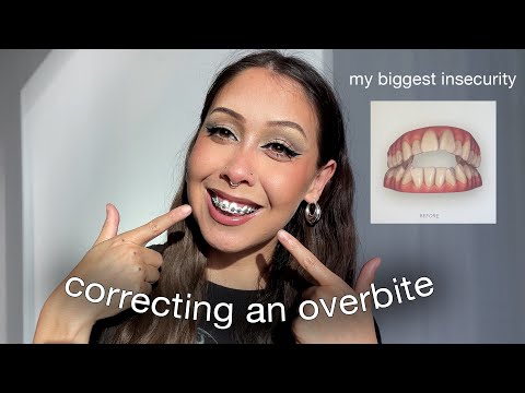 i got BRACES for the first time! | Open Bite Correction