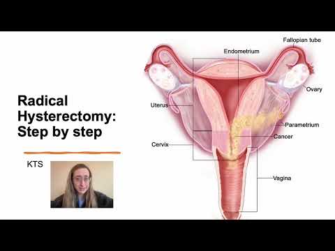 Radical Hysterectomy Step by Step