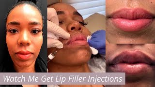 Filler for Lip Border [More Defined Lips]