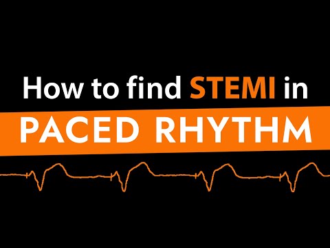 How to find STEMI in Paced Rhythm (feat. Dr Sgarbossa)