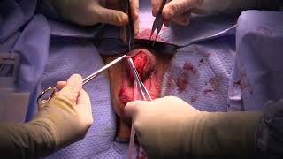 Core Videos (2024): Penile Cancer – Partial Penectomy