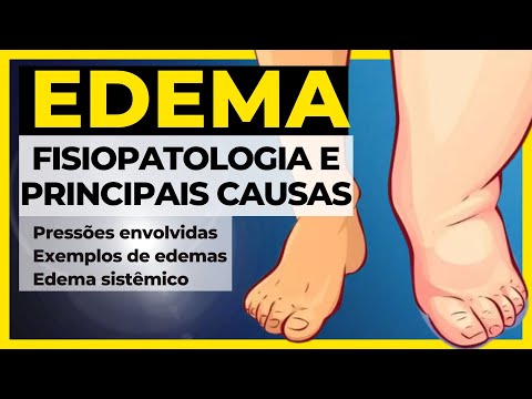 What Causes Edema? -Summary- (General Pathology) - Edema Pathophysiology [Updated]