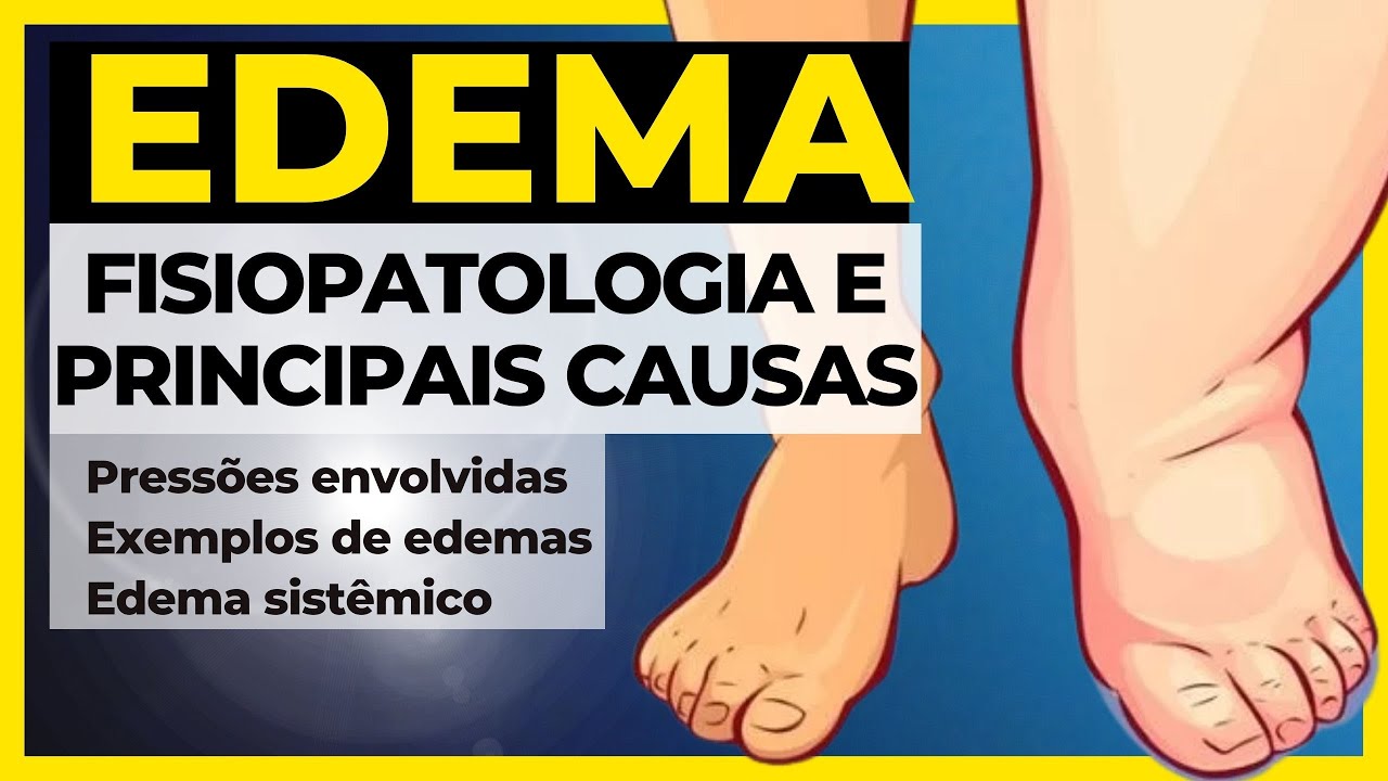 Quais as Causas de um Edema? -Resumo- (Patologia geral) - Edema Fisiopatologia [Atualizado]
