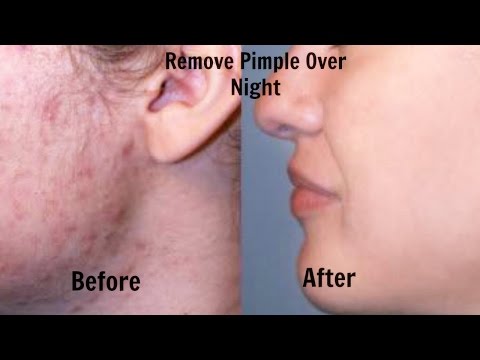 How To Remove Pimples Overnight | Acne Treatment Video