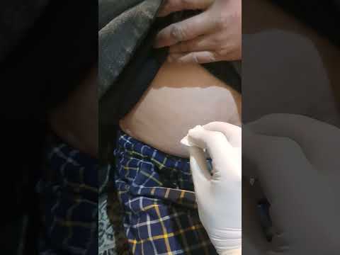 Filgrastim 300 Mcg