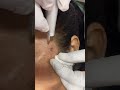 Mole Removal Dermatologist Surat Laser Treatment Co2laser Skin Care