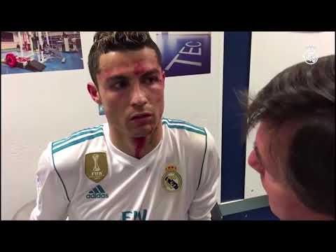 Cristiano Ronaldo Gruesome Injury- Bloody Face