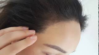 Scalp Healed receding thinning female hairline Microblading Result from 1st Session