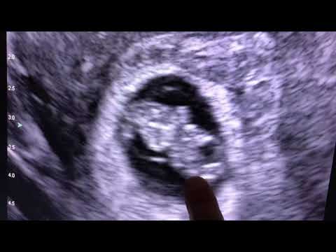 Sonogram: 9 weeks pregnant!