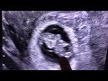 Sonogram 9 Weeks Pregnant