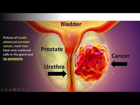 Prostate Cancer 2021 Screening and Prevention