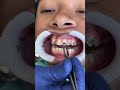 Putting Braces On