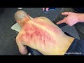 Gua Sha ASMR Compilation 30 Minutes Of Scraping Kerokan Toxins Released