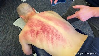 Download lagu *Gua Sha ASMR* Compilation! 30 Minutes Of Scraping, Kerokan & Toxins Released! mp3