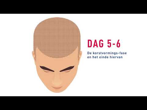 , title : 'DHI-Procedure // HairExpert - 12 Jaar Ervaring In Haartransplantatie'