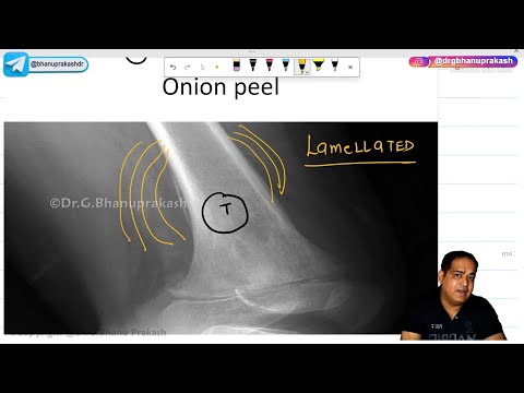 Ewing's Sarcoma (Hindi) : Orthopedics Lecture