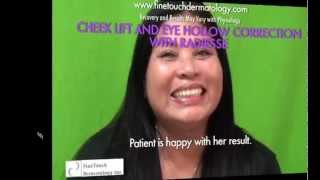 Non-Surgical Treatment For Higher Cheekbones - Before and After Radiesse