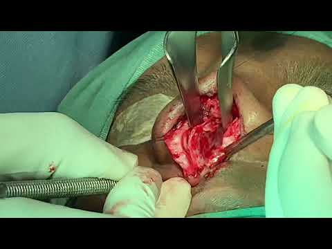 Open Structure Rhinoplasty Surgery