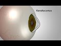 Keratoconus The Danger Of Eye Rubbing