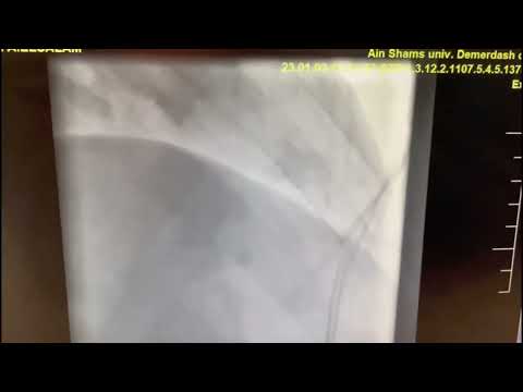 Grand round 8/1/2023(case of coronary perforation after PCI )