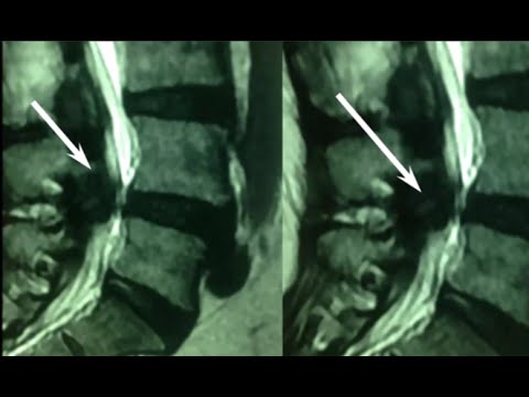 Che fa male nel fondo della parte inferiore della schiena Emangioma del rachide cervicale dimensioni della colonna vertebrale